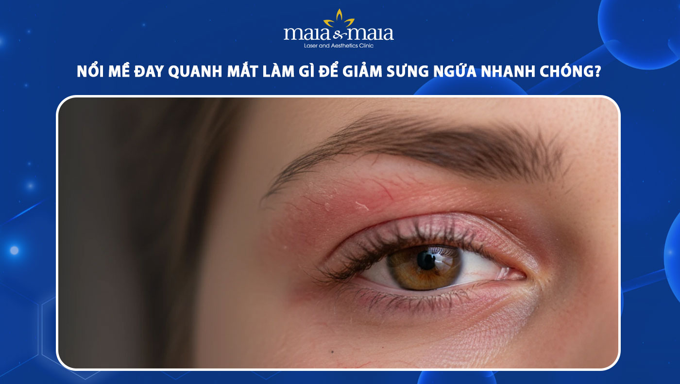 nổi mề đay quanh mắt