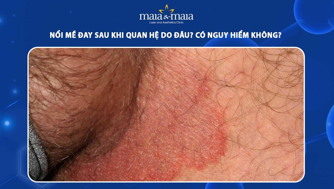 nổi mề đay sau khi quan hệ