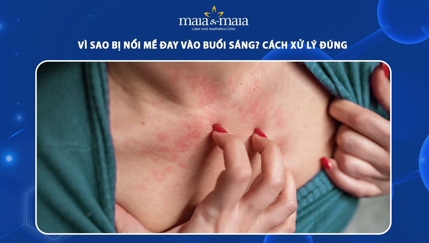 nổi mề đay vào buổi sáng