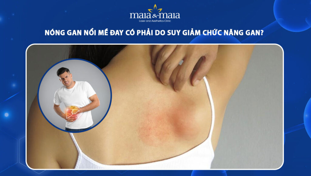 nóng gan nổi mề đay