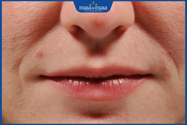 Xóa rãnh cười an toàn, hạn chế tái phát với công nghệ cao 2 rãnh cười sâu