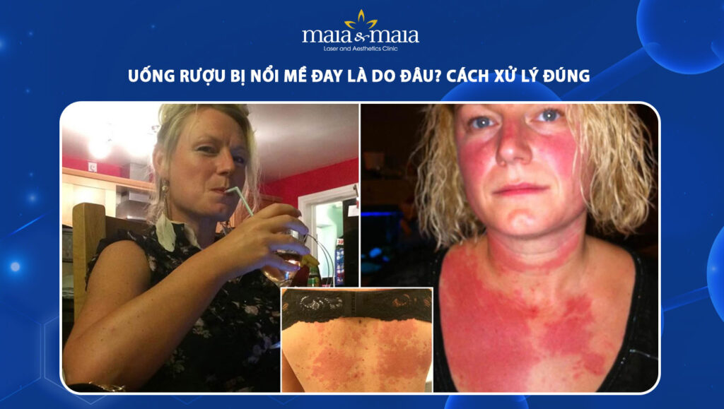 Uống rượu bị nổi mề đay do đâu? Cách xử lý đúng khi gặp phải 1 uống rượu nổi mề đay