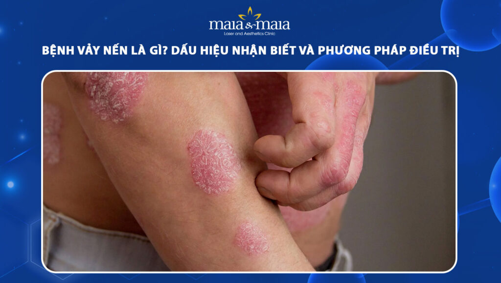 bệnh vảy nến