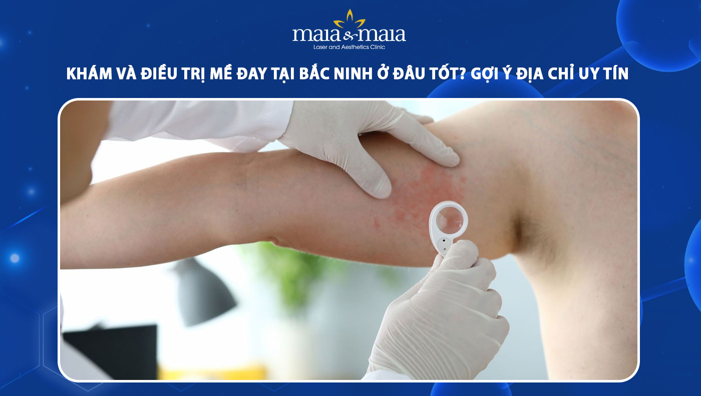 điều trị mề đay tại bắc ninh