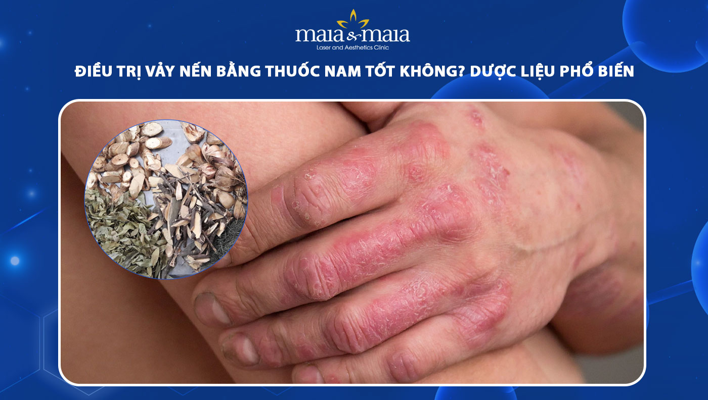 trị vảy nến bằng thuốc nam
