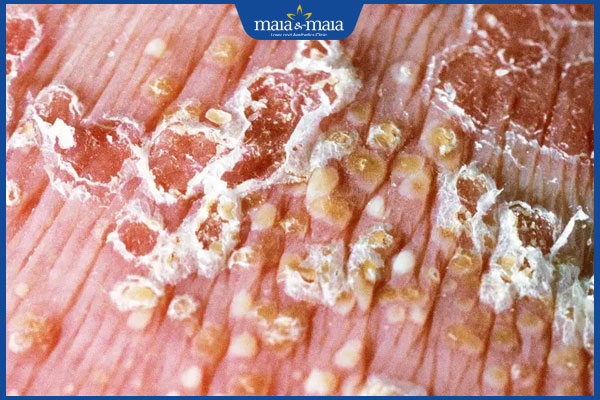 triệu chứng vảy nến thể mủ