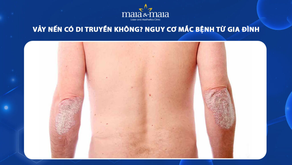 Vảy nến có di truyền không? Nguy cơ mắc bệnh từ gia đình 1 vảy nến có di truyền không