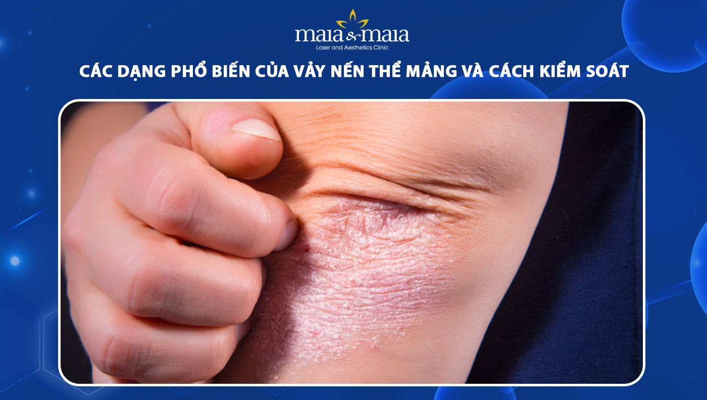 vảy nến thể mảng