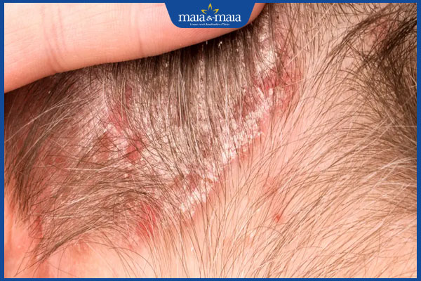 vảy nến trên da đầu