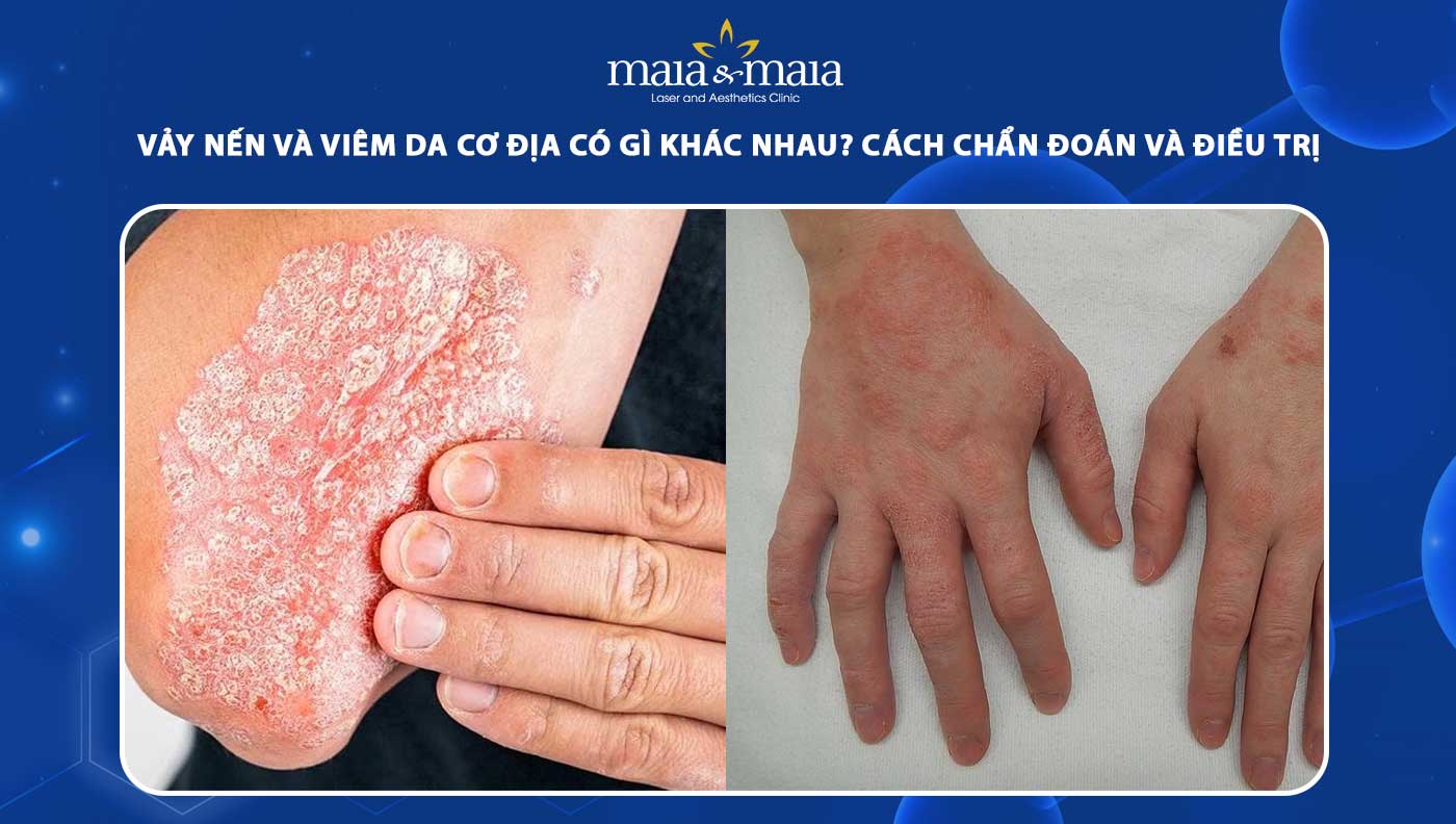 vảy nến và viêm da cơ địa