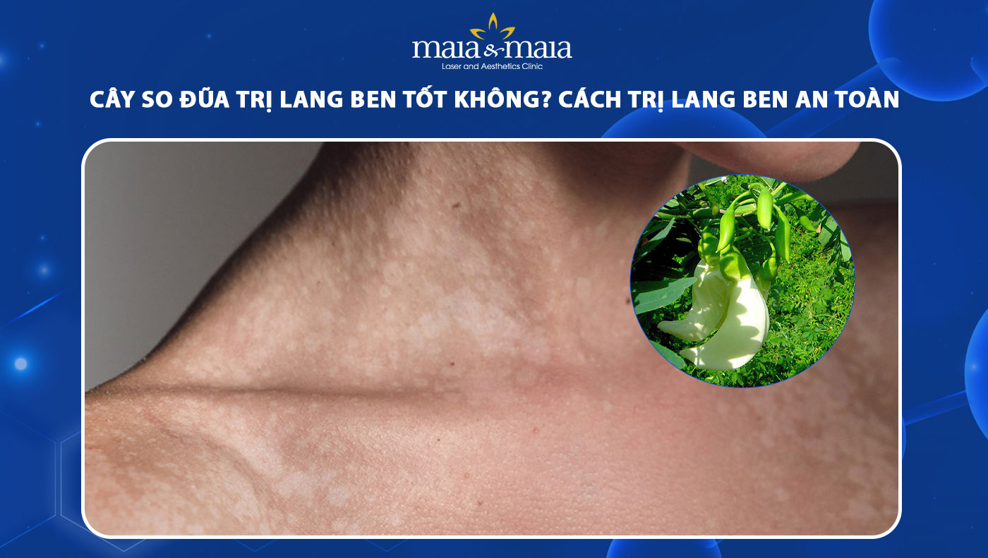 cây so đũa trị lang ben