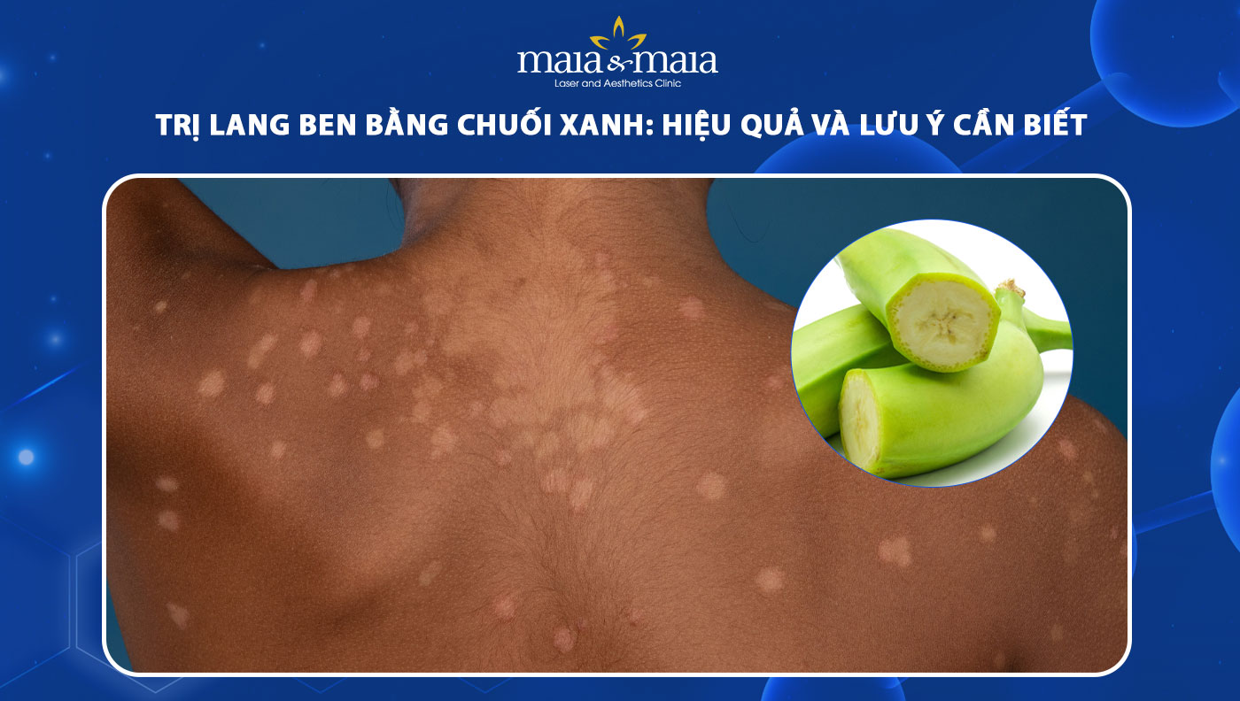 trị lang ben bằng chuối xanh