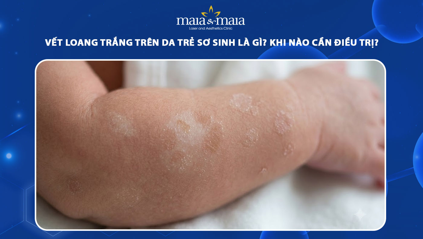 vết loang trắng trên da trẻ sơ sinh