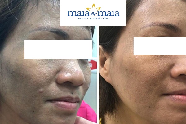 Hình ảnh : Khách hàng trước và sau khi điều trị nám da