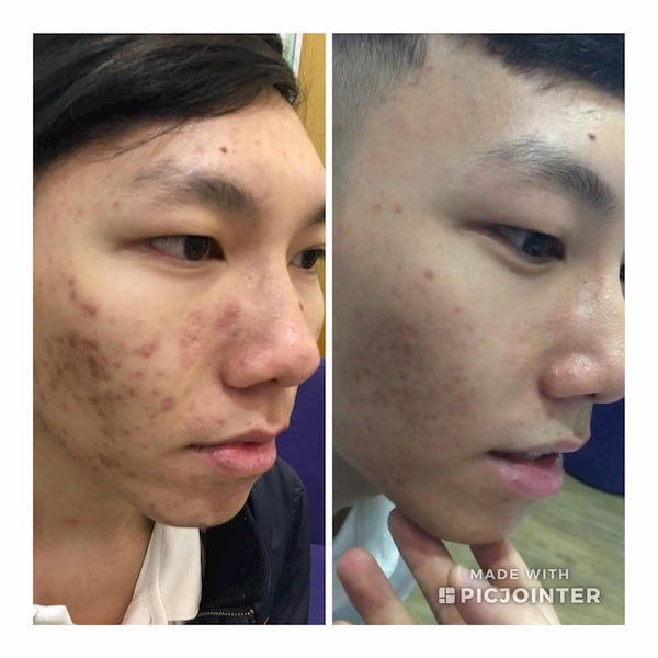 Ảnh trước và sau khi điều trị mụn trứng cá tại Maia&Maia