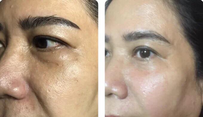 Hình ảnh: Khách hàng trước và sau khi hỗ trợ căng da bằng công nghệ Thermage