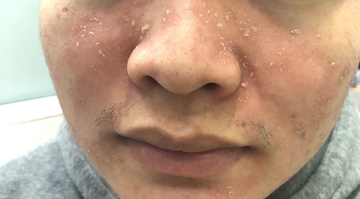 Hình ảnh: Viêm da tiết bã