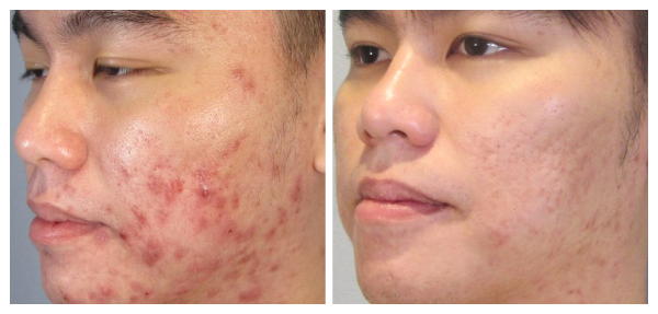 Hình ảnh: Sau khi hỗ trợ điều trị lấy nhân mụn bằng phương pháp Laser DIOT