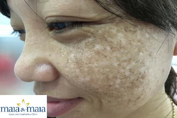 Khách hàng bị nám hỗn hợp Khách hàng bị nám hỗn hợp