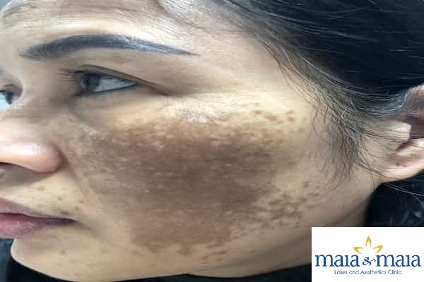 Khách hàng bị nám da Khách hàng bị nám da