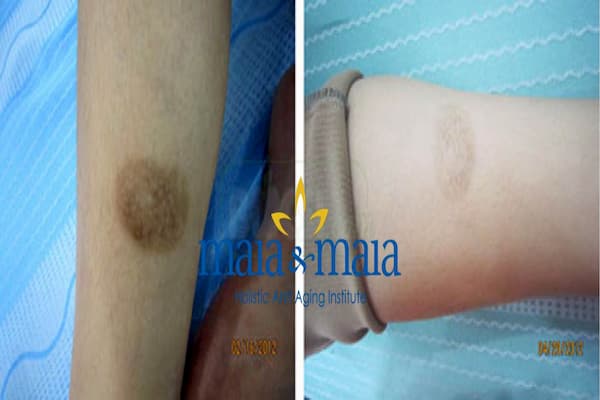 sẹo thâm vùng chân sẹo thâm vùng chân