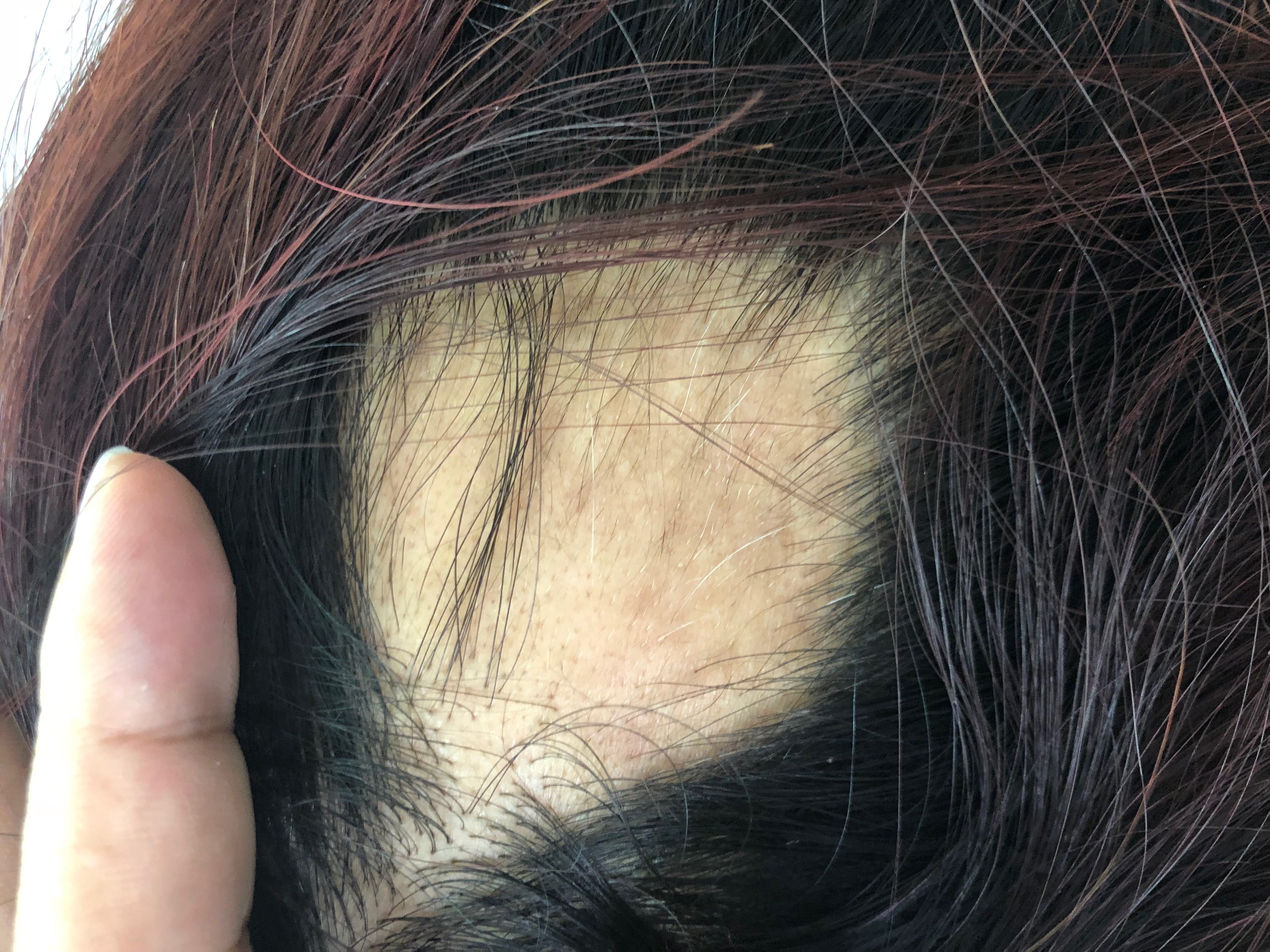 Hình ảnh: Rụng tóc thể mảng
