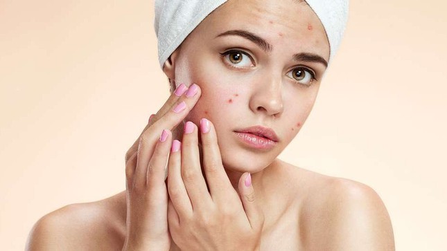 Hình ảnh: Mụn trứng cá- Nỗi ám ảnh của làn da