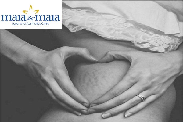Rạn da vùng bụng Rạn da vùng bụng
