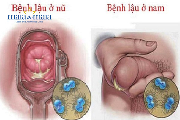 Hình ảnh: Bệnh lậu Hình ảnh: Bệnh lậu
