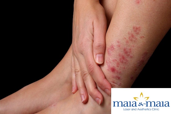 Bệnh vảy nến ở chân- Phòng khám chuyên khoa da liễu Maia Vảy nến ở chân