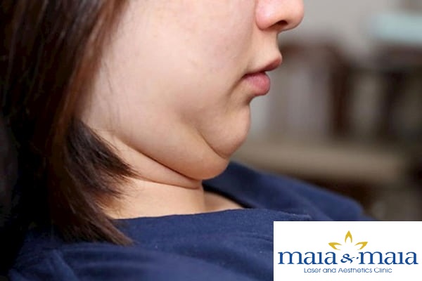 Mỡ thừa vùng nọng cằm Mỡ thừa vùng nọng cằm