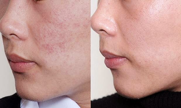Hình ảnh: Khách hàng đã được hỗ trợ điều trị sẹo thâm bằng Laser Mixel