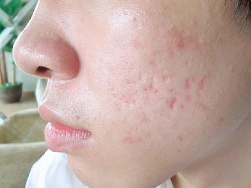 Hình ảnh: Sẹo lõm, sẹo rỗ để lại trên mặt