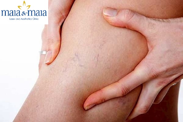 Giãn mao mạch vùng đùi Giãn mao mạch vùng đùi
