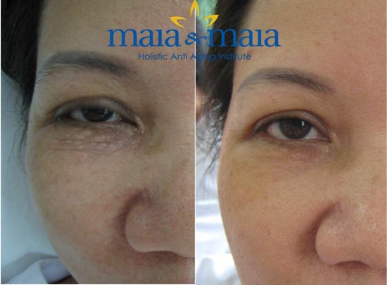 Hình ảnh trước sau điều trị xóa bọng mắt bằng CN Gold Laser tại Pk chuyên khoa Da liễu Maia Hình ảnh trước sau điều trị