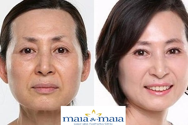 hỗ trợ điều trị trẻ hóa da bằng công nghệ Laser Toning hỗ trợ điều trị trẻ hóa da bằng công nghệ Laser Toning