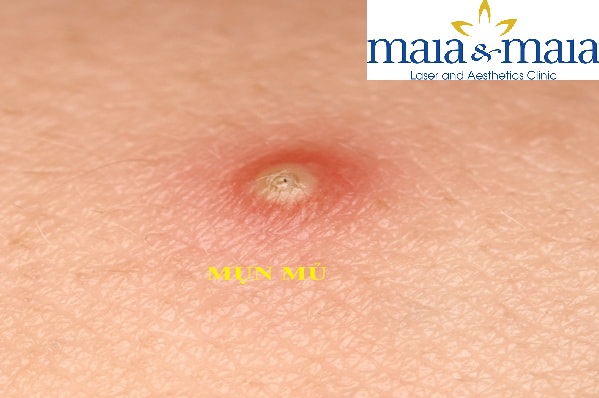 Hình ảnh : Mụn mủ gây đau nhức, khó chịu Hình ảnh : Mụn mủ gây đau nhức, khó chịu