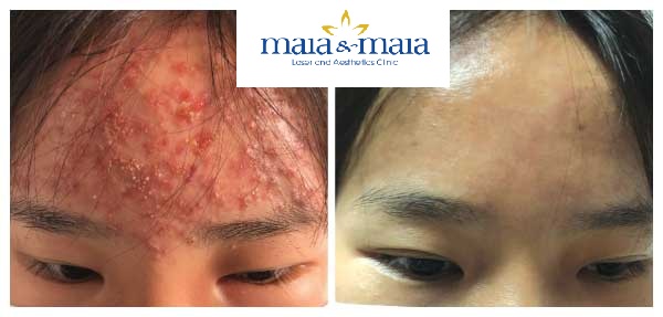 Hình ảnh: Khách hàng trước và sau khi hỗ trợ điều trị mụn Hình ảnh: Khách hàng trước và sau khi hỗ trợ điều trị mụn