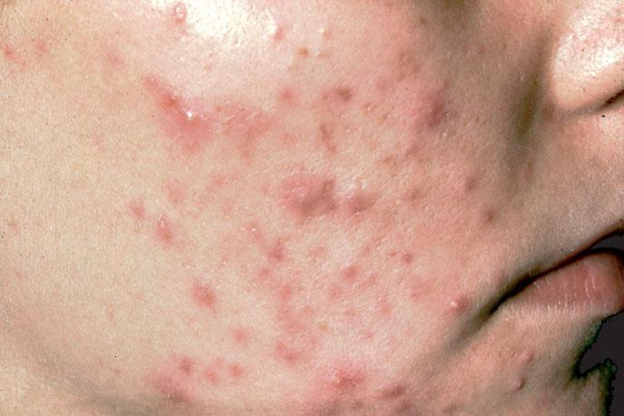 Hình ảnh: Mụn trứng cá