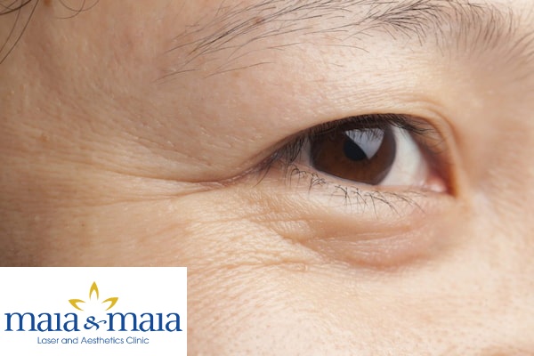 Hình ảnh nếp nhăn mắt tại Pk chuyên khoa Da liễu Maia Hình ảnh nếp nhăn mắt