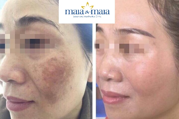Hình ảnh : Nám da sau sinh trên má người bệnh Hình ảnh : Nám da sau sinh trên má người bệnh