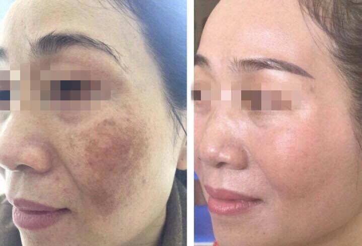 Hình ảnh: Khách hàng trước và sau hỗ trợ điều trị nám