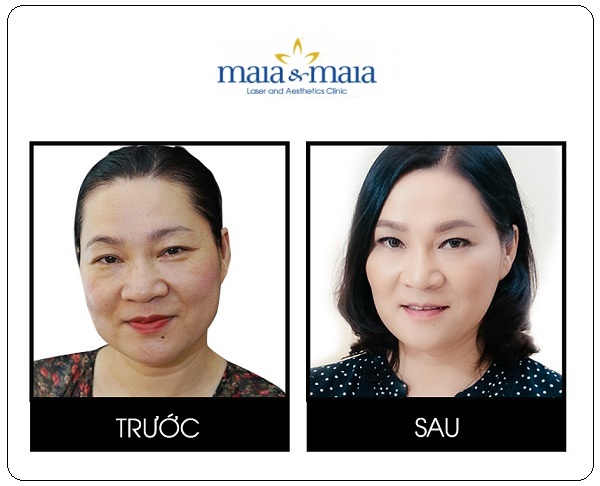 Hình ảnh trước và sau khi xóa nhăn mắt của MC - BTV Kim Ngân Hình ảnh trước và sau khi xóa nhăn mắt của MC - BTV Kim Ngân