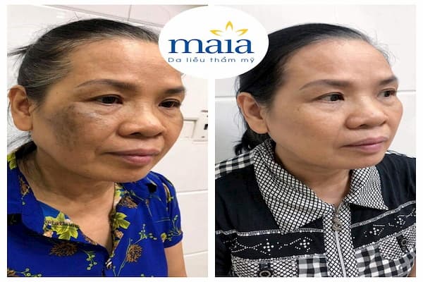 Khách hàng trước - sau khi được hỗ trợ điều trị nám da Khách hàng trước - sau khi được hỗ trợ điều trị nám da