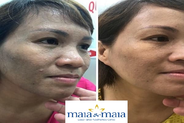 Khách hàng bị rối loạn chuyển hóa sắc tố da được hỗ trợ điều trị Khách hàng bị rối loạn chuyển hóa sắc tố da được hỗ trợ điều trị
