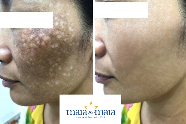 Thạc sĩ Bác sĩ đang hỗ trợ điều trị nám da bằng Laser Picosur Thạc sĩ Bác sĩ đang hỗ trợ điều trị nám da bằng Laser Picosur