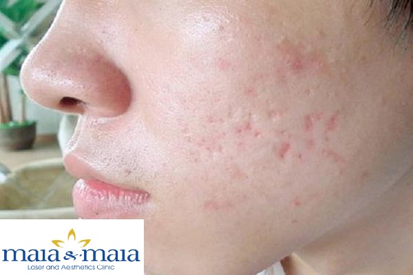 sẹo rỗ - sẹo lõm sau mụn sẹo rỗ - sẹo lõm sau mụn