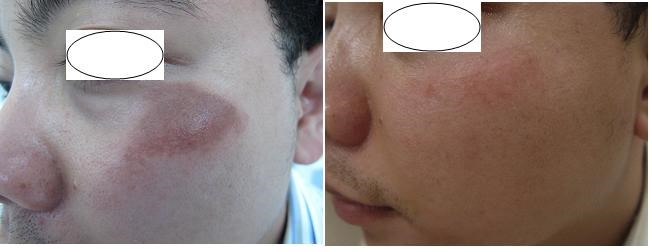Hình ảnh: Khách hàng sau khi hỗ trợ điều trị sẹo thâm.