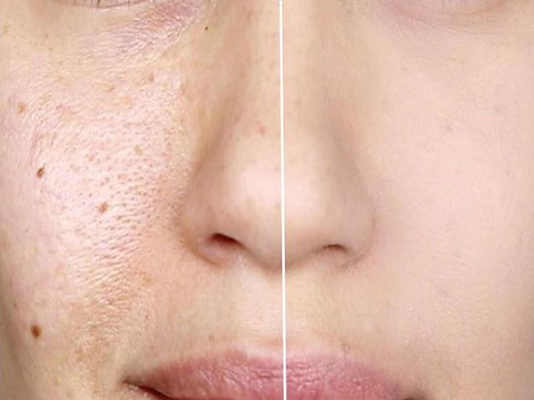 Hình ảnh: Sau khi thu nhỏ lỗ chân lông bằng phương pháp cao cấp