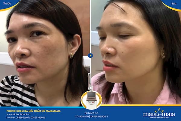 Trước - sau khi được hỗ trợ điều trị nám da Trước - sau khi được hỗ trợ điều trị nám da